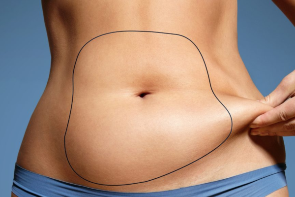 Your Liposuction Options: Traditional to Advanced Techniques